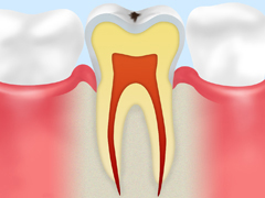 【CＯ：ごく初期の虫歯】