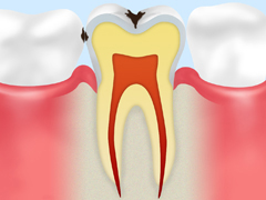 【C1：エナメル質の虫歯】