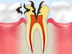 【C2：象牙質の虫歯】