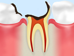 【C3：神経に達した虫歯】