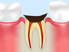 【C4：末期の虫歯】