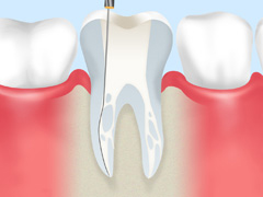 重度の虫歯には根管治療